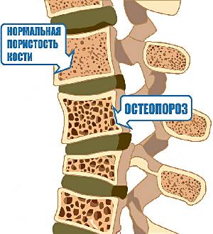 нормальная пористость кости и остеопороз